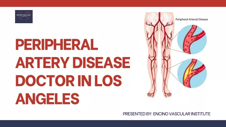 peripheral artery disease doctor in los angeles