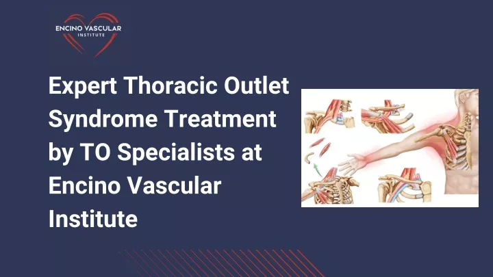 expert thoracic outlet syndrome treatment
