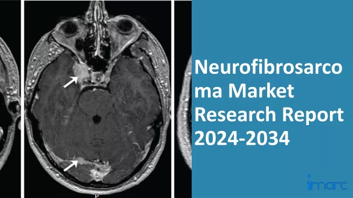 neurofibrosarcoma market research report 2024 2034