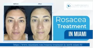 Revitalize Your Skin with Leading Rosacea Treatment in Miami With Us!