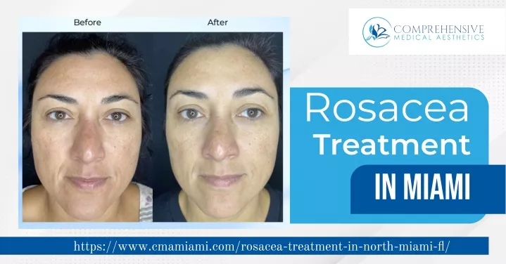 rosacea treatment in miami