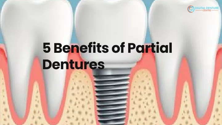 5 benefits of partial dentures