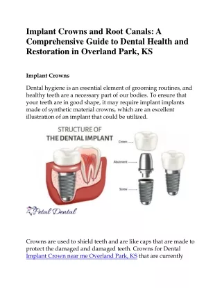 Implant Crowns and Root Canals