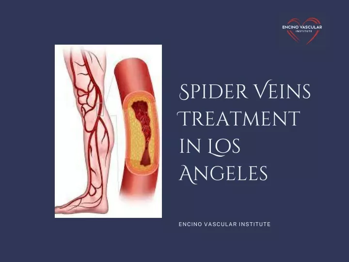 spider veins treatment in los angeles