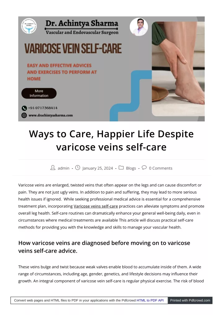 ways to care happier life despite varicose veins