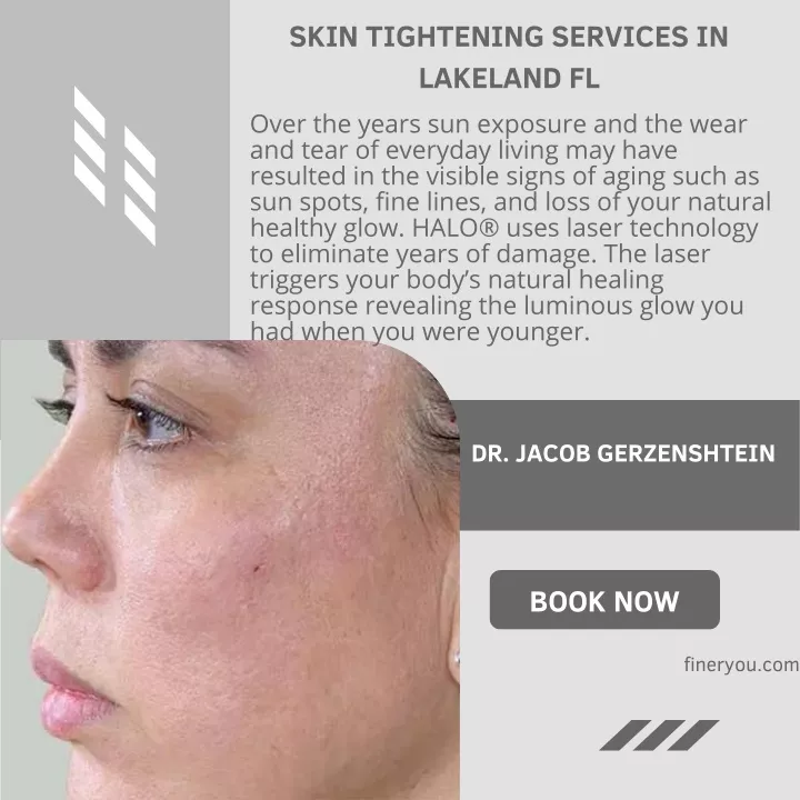 skin tightening services in lakeland fl over