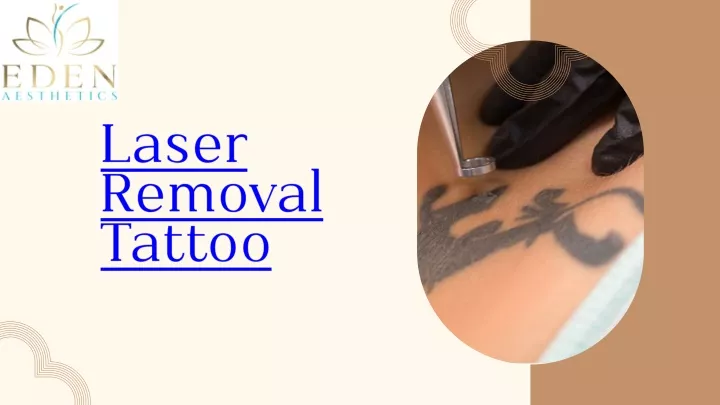 laser removal tattoo