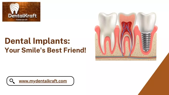 dental implants your smile s best friend