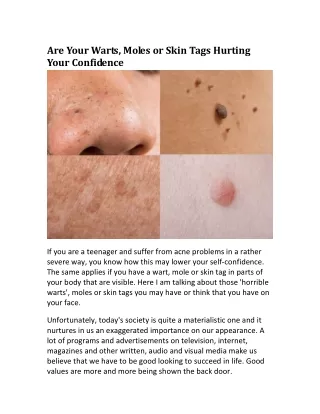 Are Your Warts, Moles Or Skin Tags Hurting Your Confidence