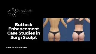 Buttock Enhancement Case Studies in SurgiSculpt
