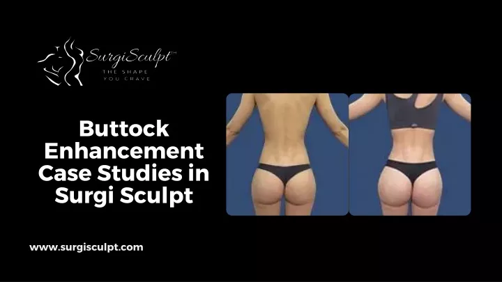 buttock enhancement case studies in surgi sculpt