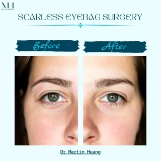 Unveiling the Advantages of Scarless Eyebag Surgery through Fat Removal