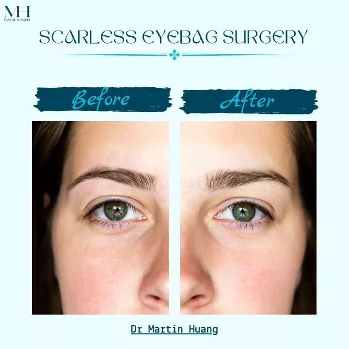 scarless eyebag surgery