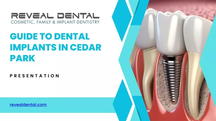 guide to dental implants in cedar park