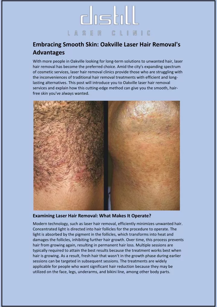embracing smooth skin oakville laser hair removal