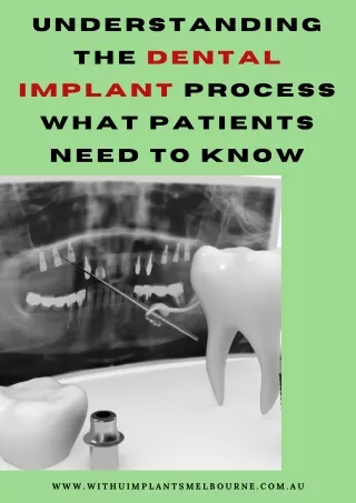 Understanding the Dental Implant Process What Patients Need to Know