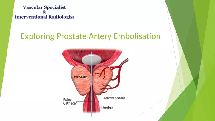 exploring prostate artery embolisation