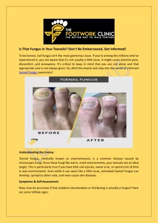 Is That Fungus in Your Toenails? Don't Be Embarrassed, Get Informed!