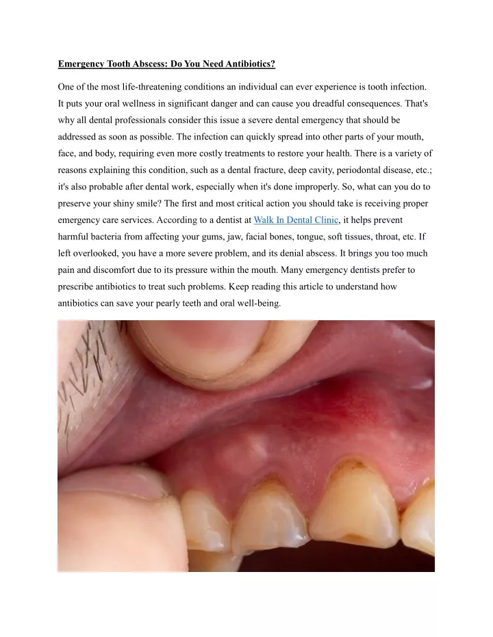 emergency tooth abscess do you need antibiotics