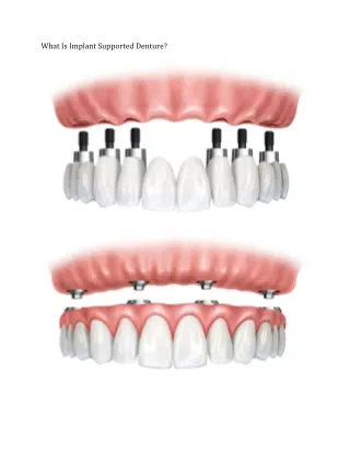 What Is Implant Supported Denture