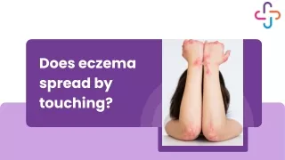 Does eczema spread by touching?