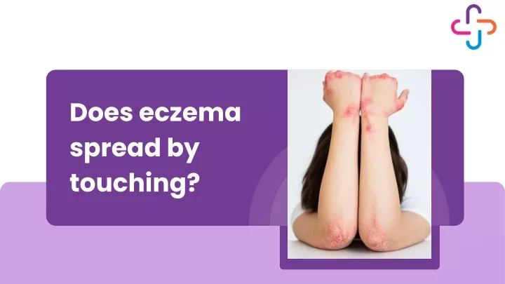 does eczema spread by touching