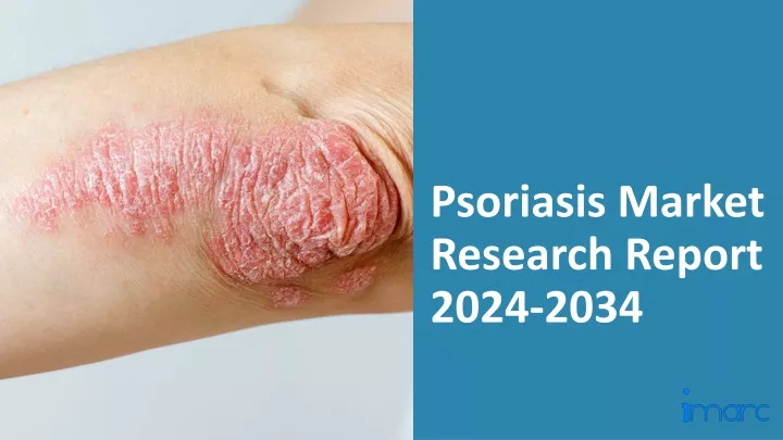 psoriasis market research report 2024 2034