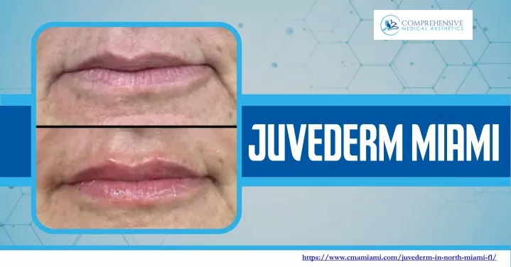 https www cmamiami com juvederm in north miami fl