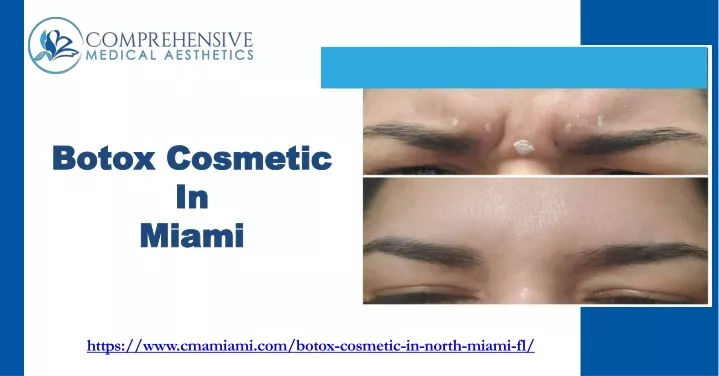 botox cosmetic in miami