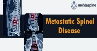 Metastatic Spinal Disease | Its Treatment Options