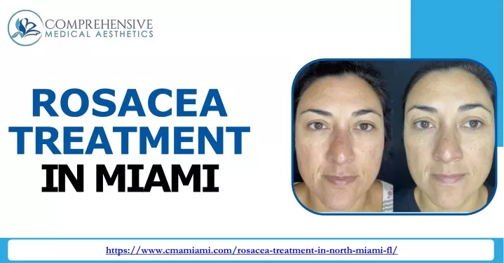 rosacea treatment in miami