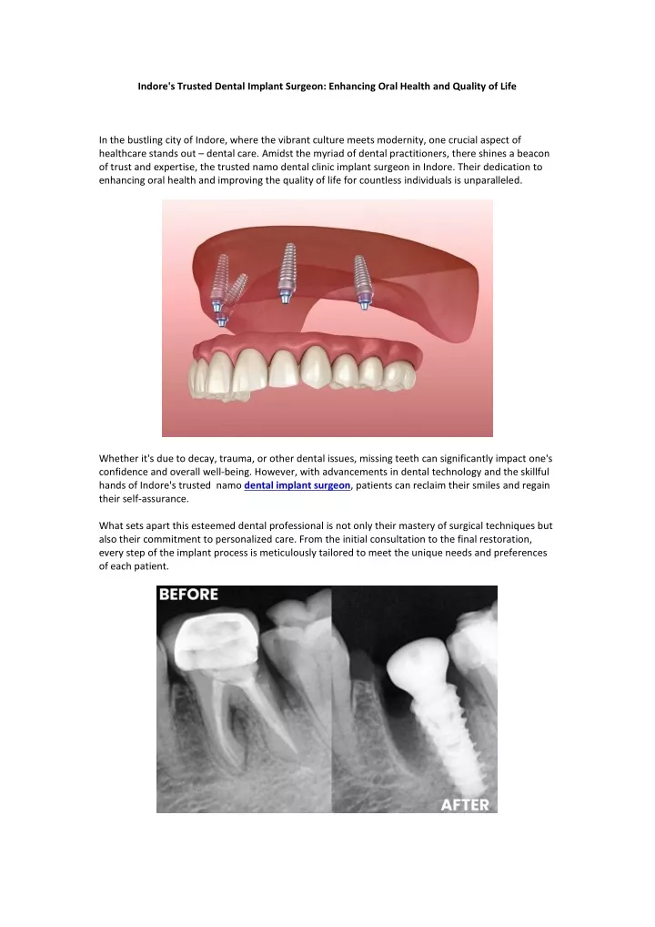 indore s trusted dental implant surgeon enhancing