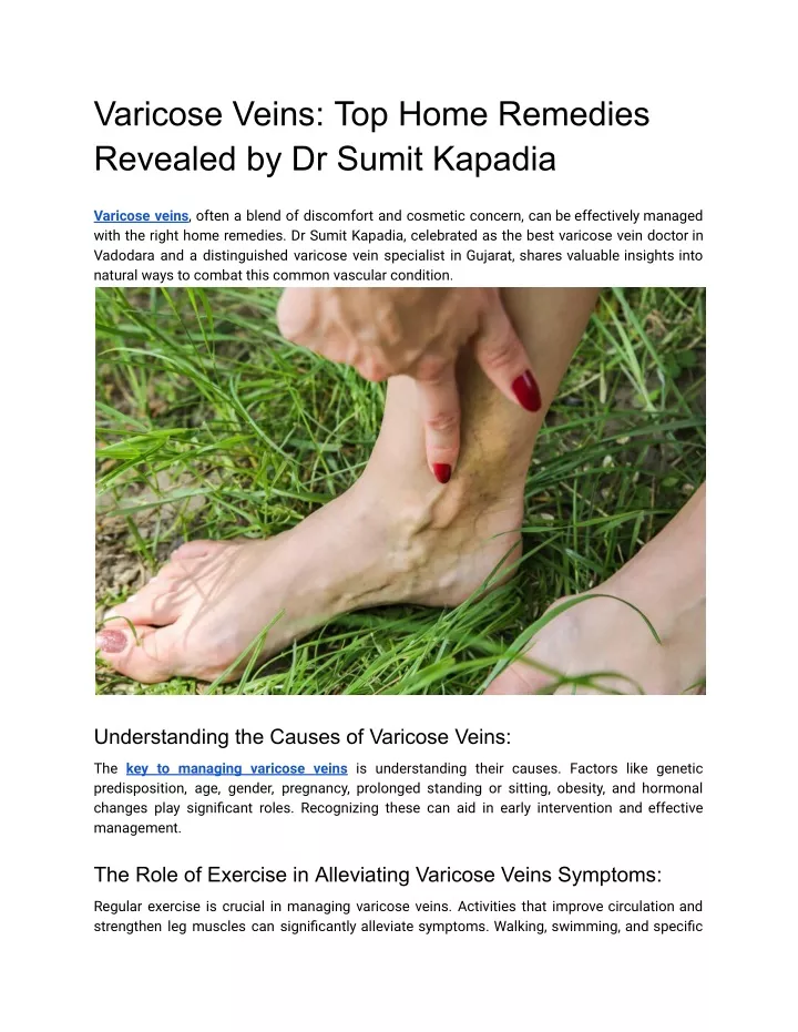 varicose veins top home remedies revealed