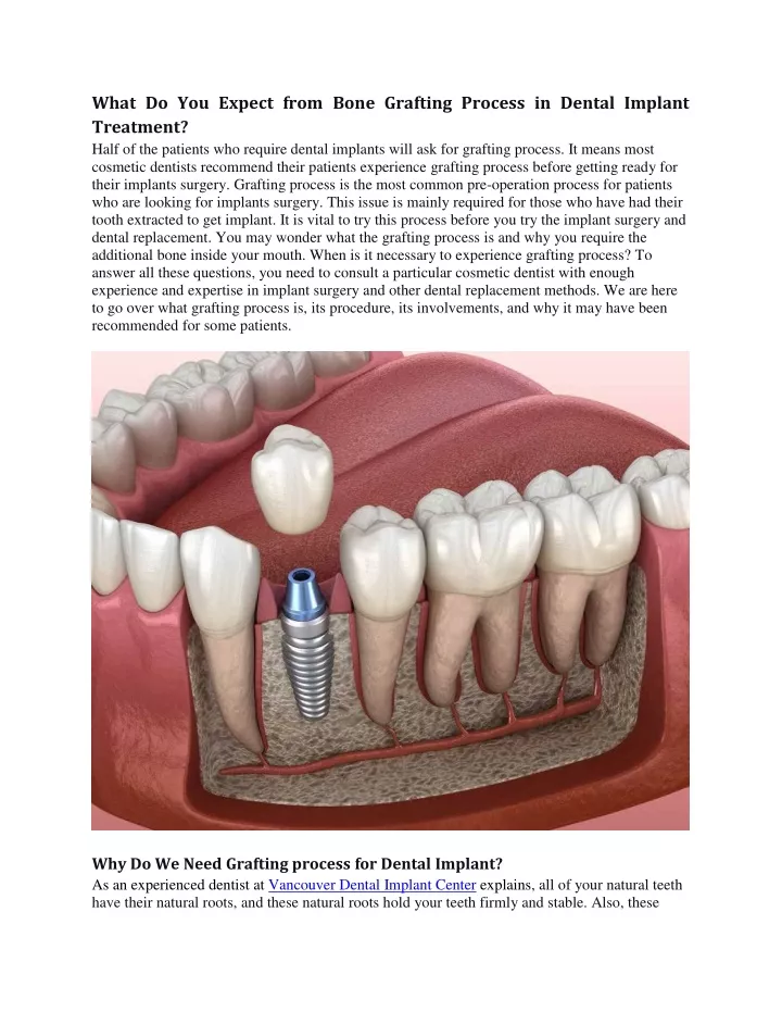 what do you expect from bone grafting process