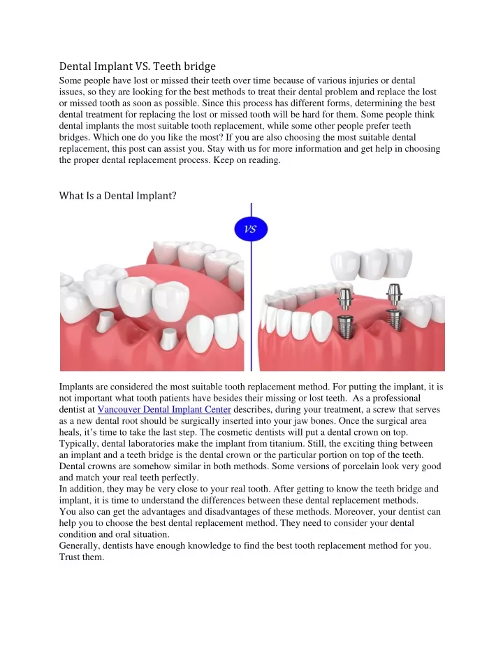 dental implant vs teeth bridge some people have
