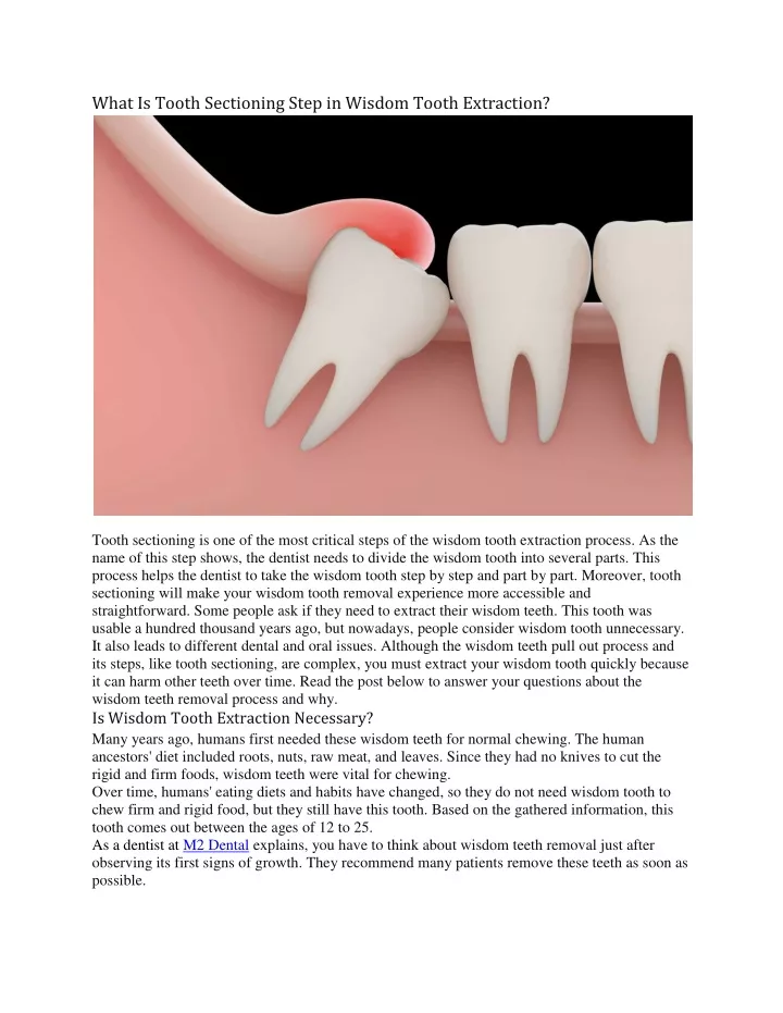 what is tooth sectioning step in wisdom tooth