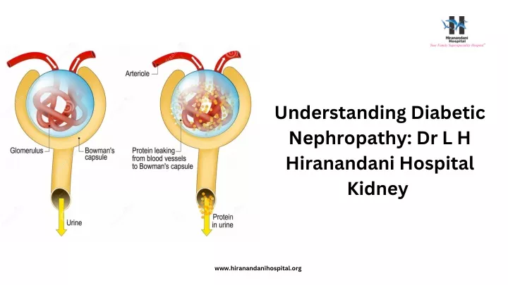 understanding diabetic nephropathy