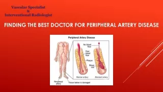 Finding the Best Doctor for Peripheral Artery Disease