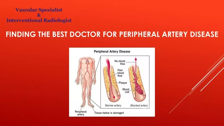 finding the best doctor for peripheral artery disease