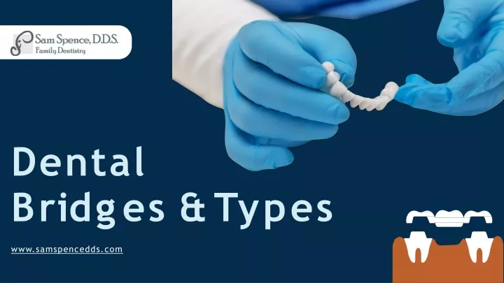 PPT - Dental Bridges And It's Types Explained | Sam Spence D.D.S ...