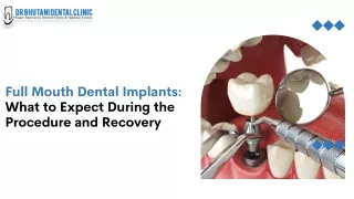 Full Mouth Dental Implants What to Expect During the Procedure and Recovery