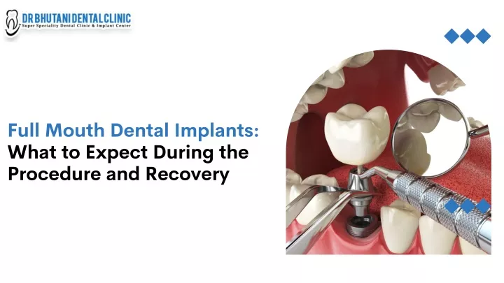 full mouth dental implants what to expect during