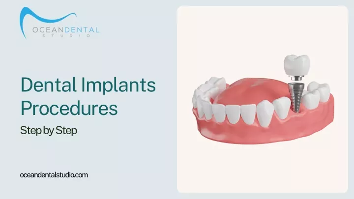 dental implants procedures step by step