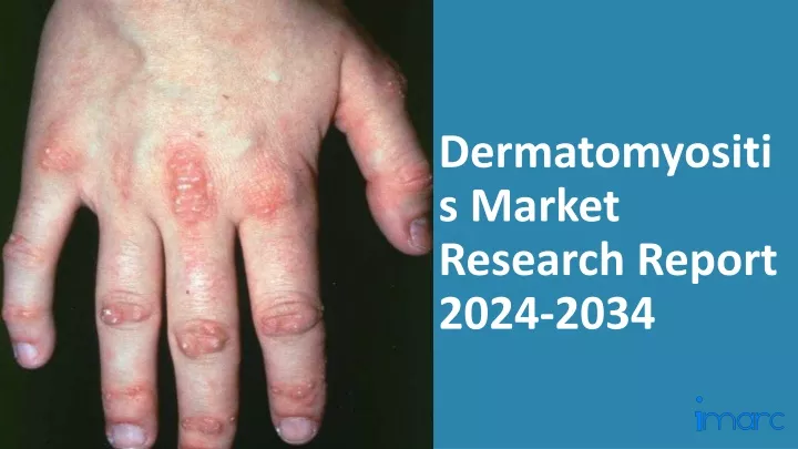 dermatomyositis market research report 2024 2034