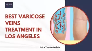 Best Varicose Veins Treatment in Los Angeles