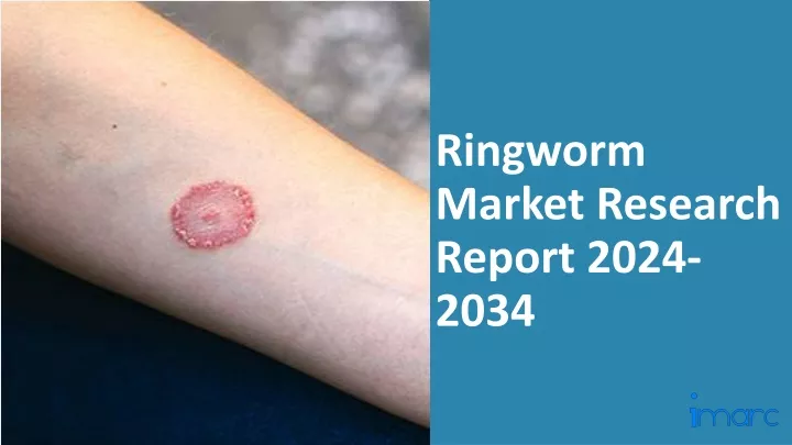ringworm market research report 2024 2034