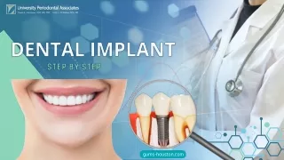 Dental implant process explained