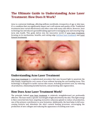 The Ultimate Guide to Understanding Acne Laser Treatment