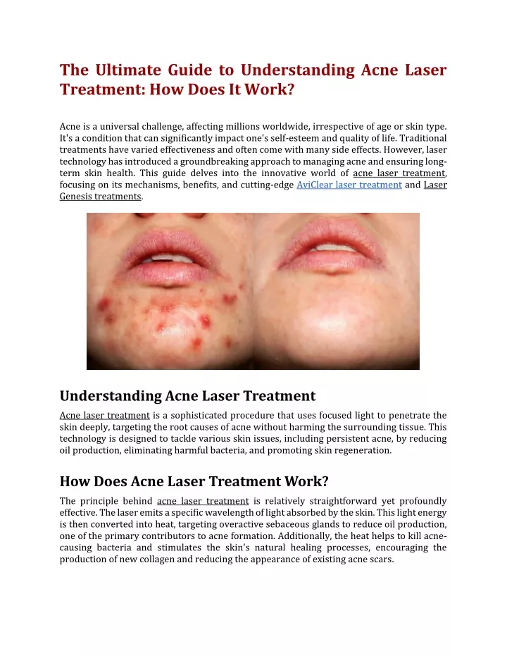 the ultimate guide to understanding acne laser