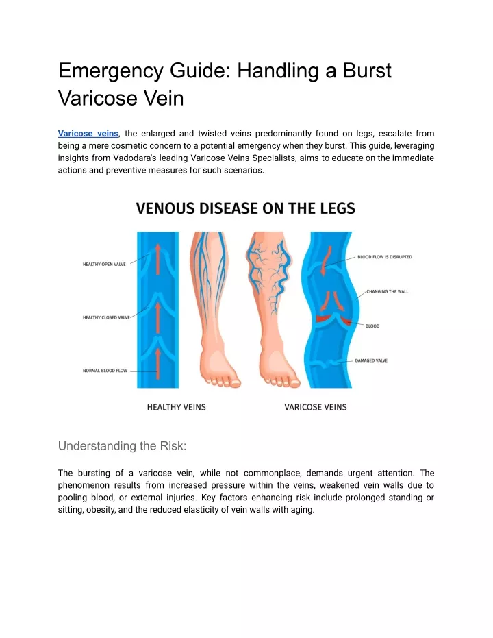 emergency guide handling a burst varicose vein